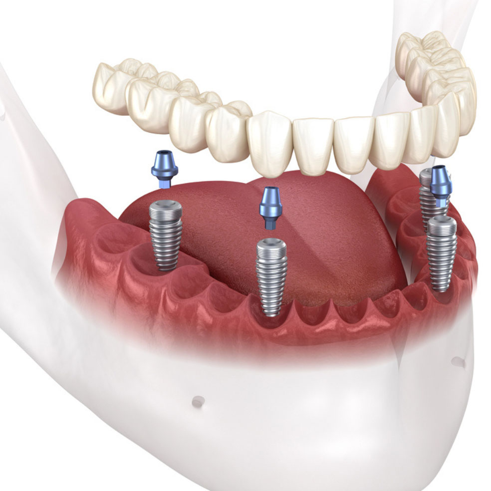All on Four Implants