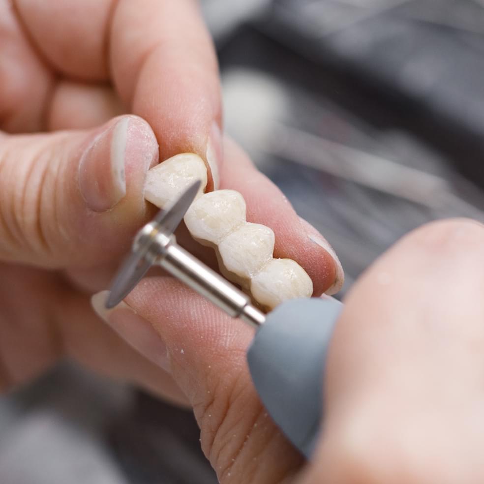 My Dental Hub dental model showing a tooth supported bridge restoration in Skokie, IL