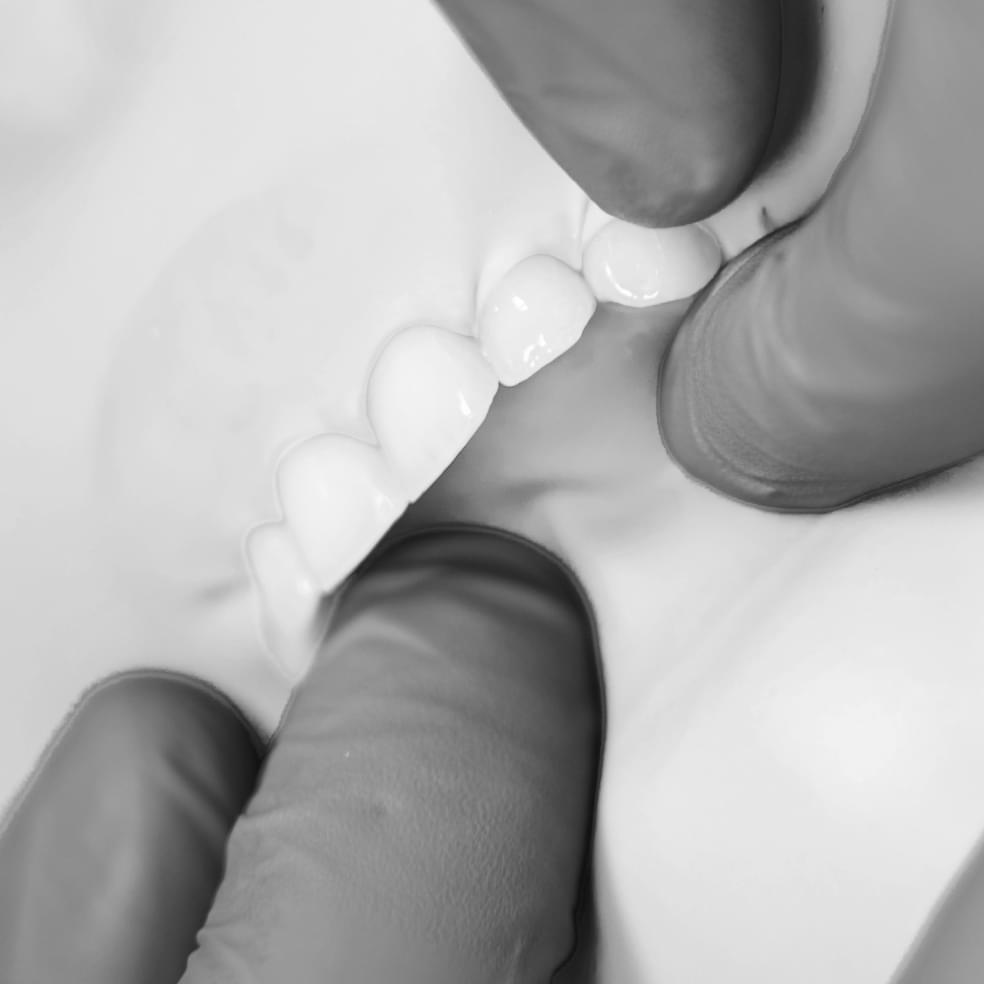 My Dental Hub close-up of a fixed dental bridge restoration in Skokie, IL
