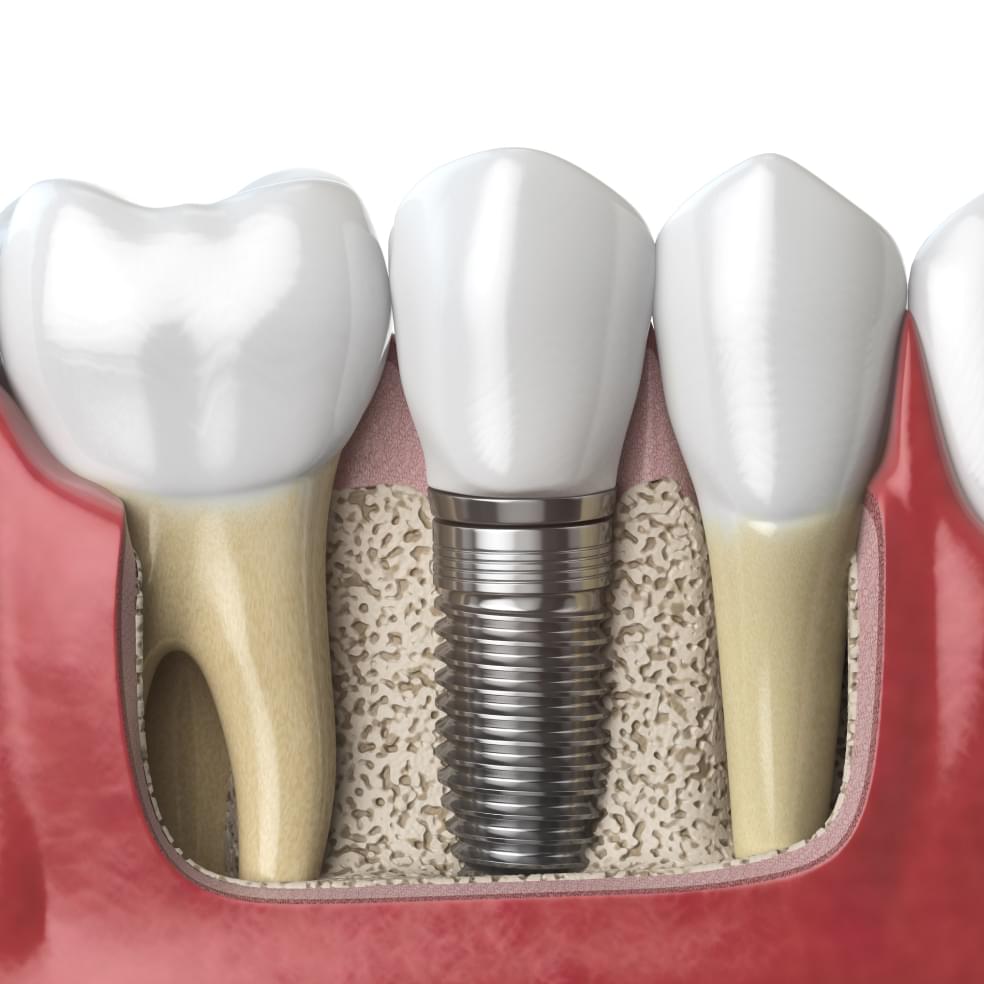 My Dental Hub diagram illustrating a tooth replacement implant procedure in Skokie, IL