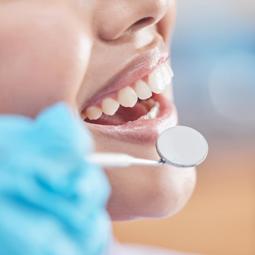 Cavity Filling