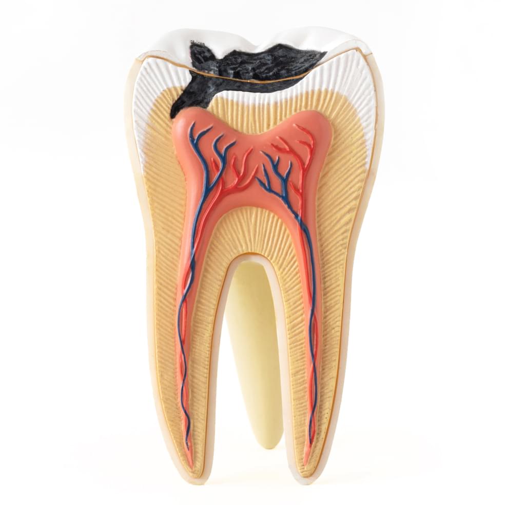 My Dental Hub diagram illustrating the root canal treatment process in Skokie, IL