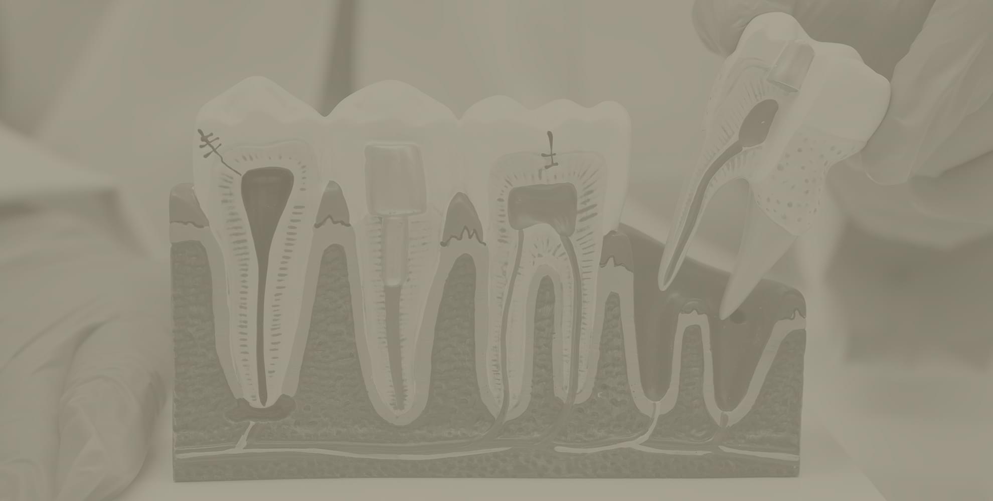 My Dental Hub hero banner image promoting root canal therapy services in Skokie, IL