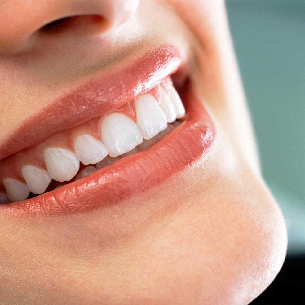 My Dental Hub close-up of natural looking porcelain veneers on a smile in Skokie, IL