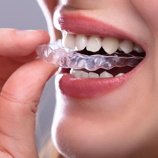 My Dental Hub patient smiling while wearing invisible clear braces in Skokie, IL