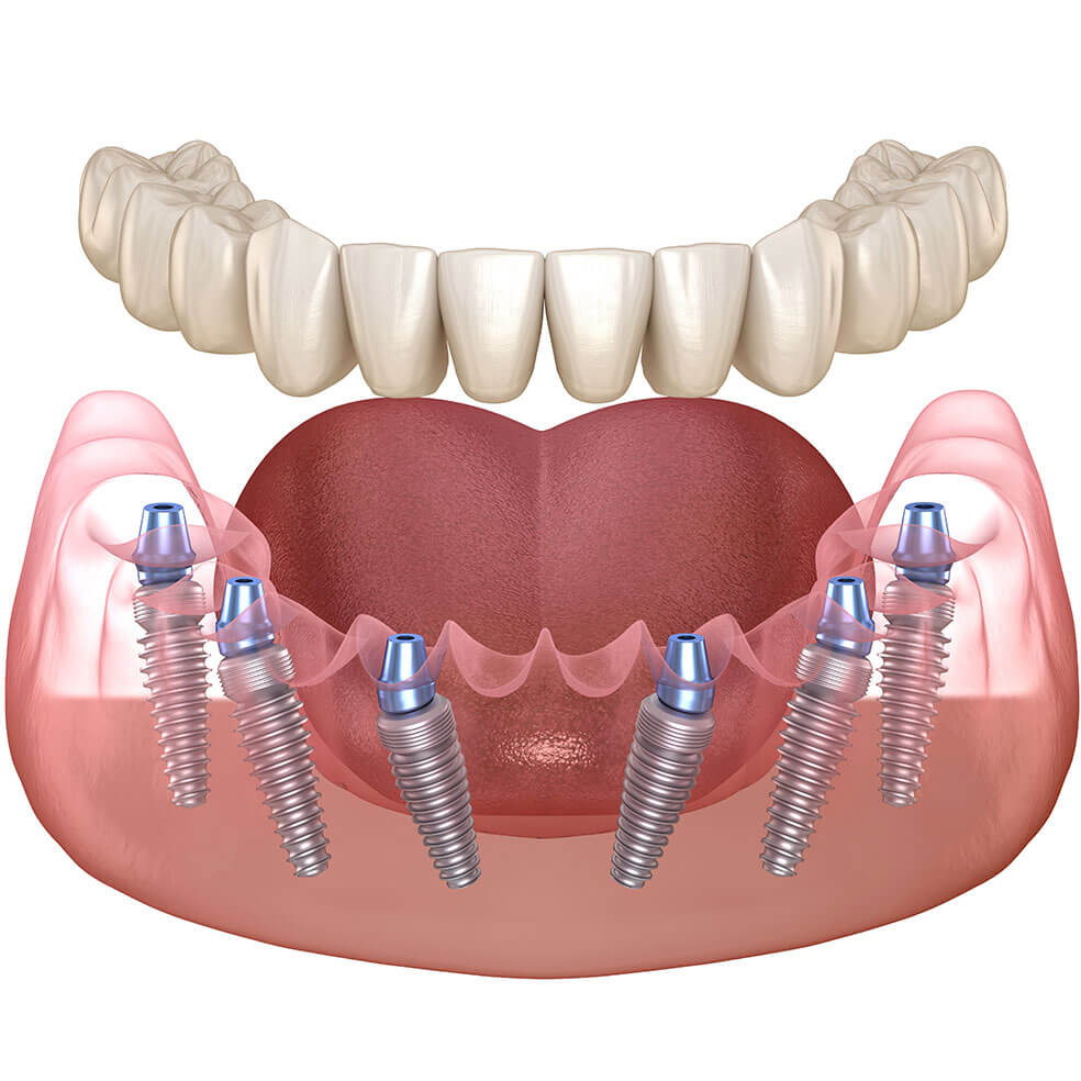 My Dental Hub diagram illustrating the All-on-6 dental implant procedure in Skokie, IL